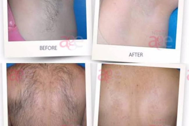 Laser Hair Removal Nouvel Age Clinics