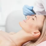 Fractional laser for face before and after
